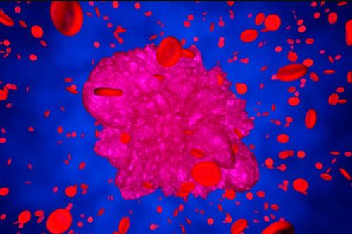 نتایج مثبت یک درمان جدید سرطان خون بر 73 درصد از بیماران