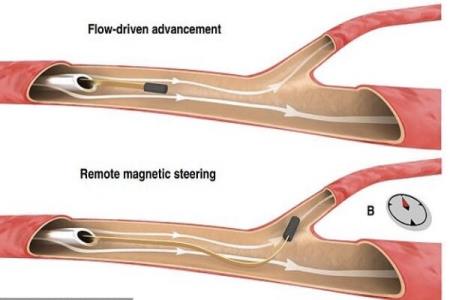ابداع سیم نازكی كه در رگ های مغزی حركت می كند