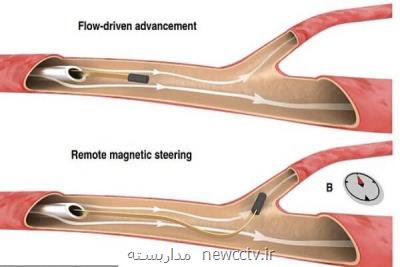 ابداع سیم نازكی كه در رگ های مغزی حركت می كند
